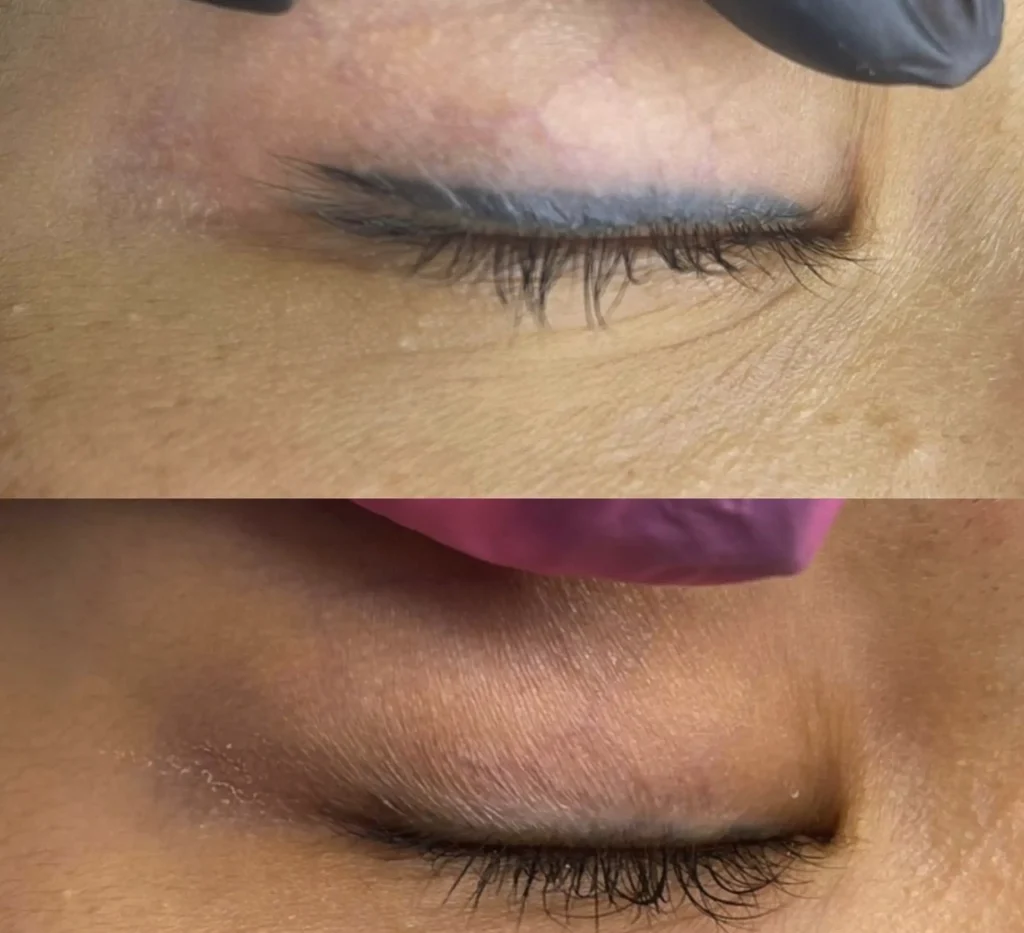 cosmetic eyeliner tattoo removal