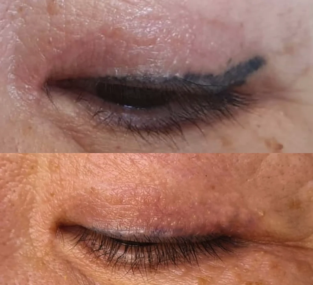 eyeliner tattoo removal before and after