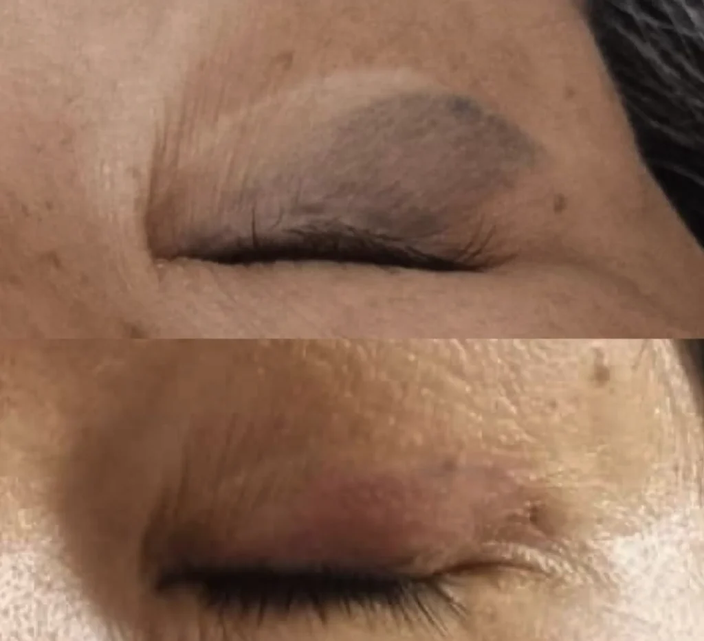 eyeliner tattoo removal cost