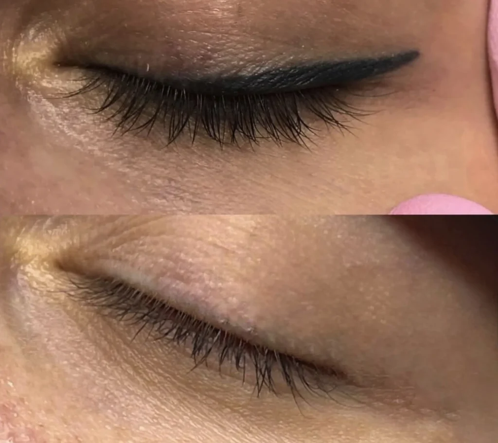 eyeliner tattoo removal melbourne