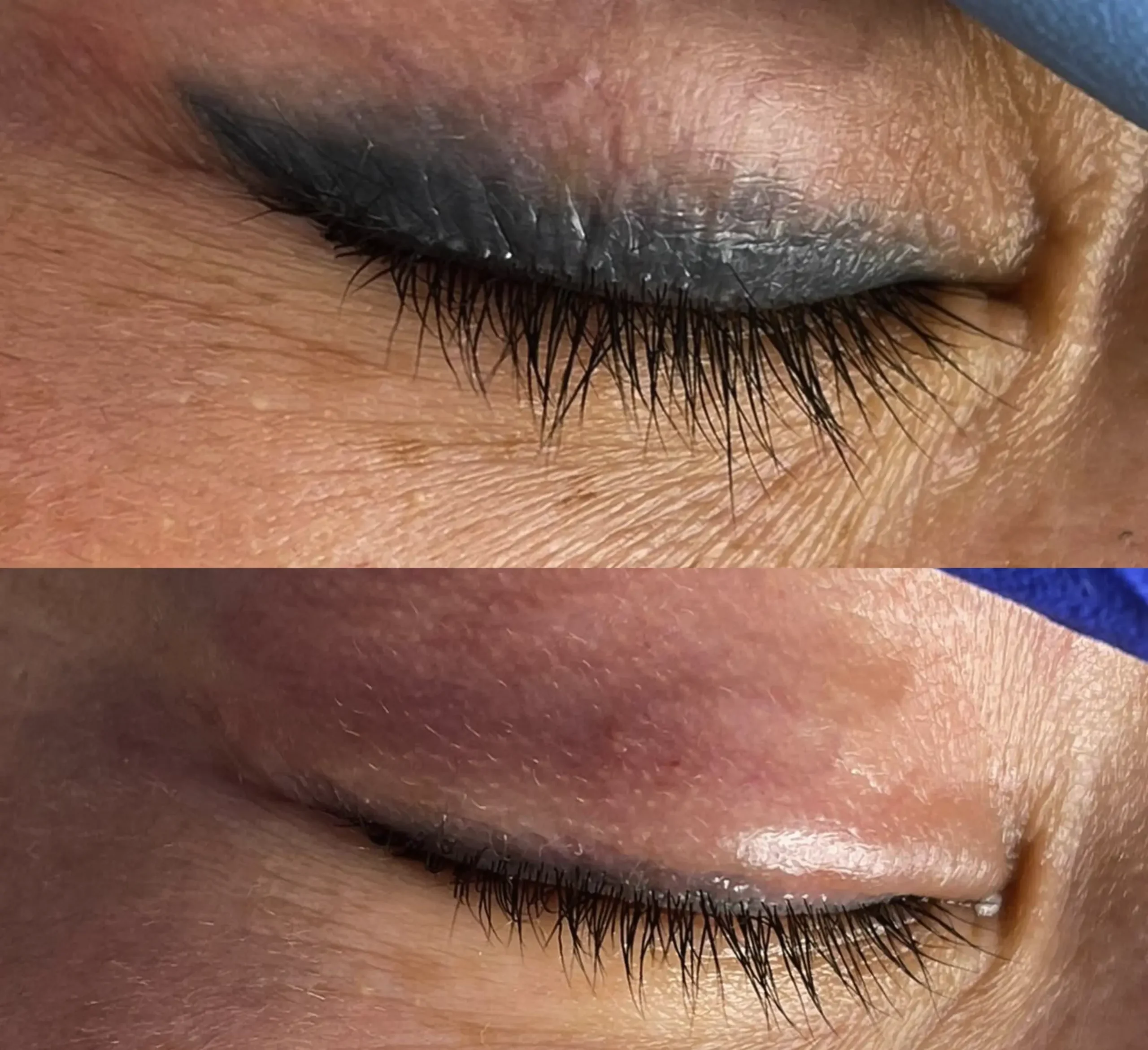 eyeliner tattoo removal