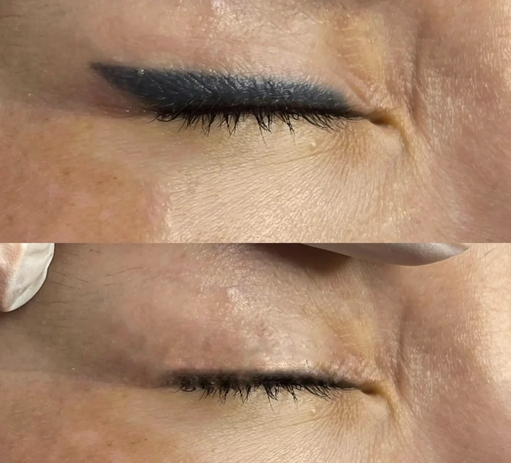 laser eyeliner tattoo removal