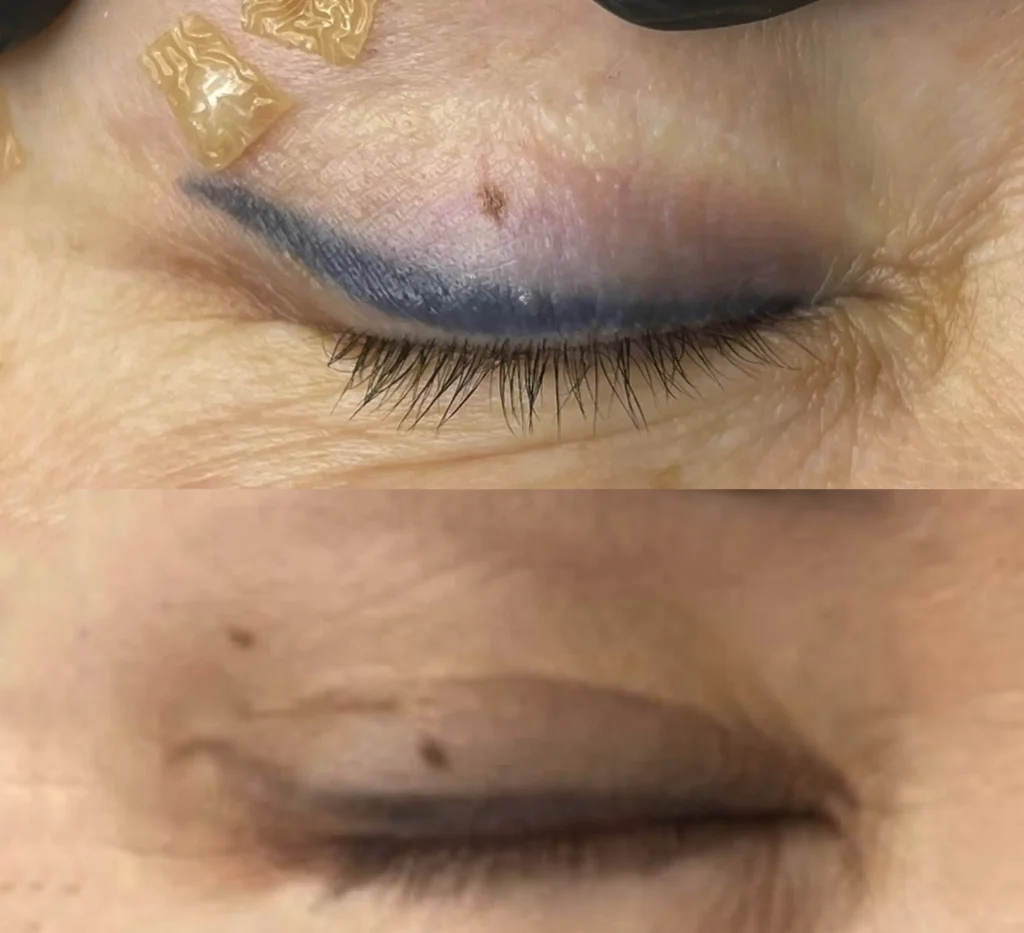 laser eyeliner tattoo removal near me