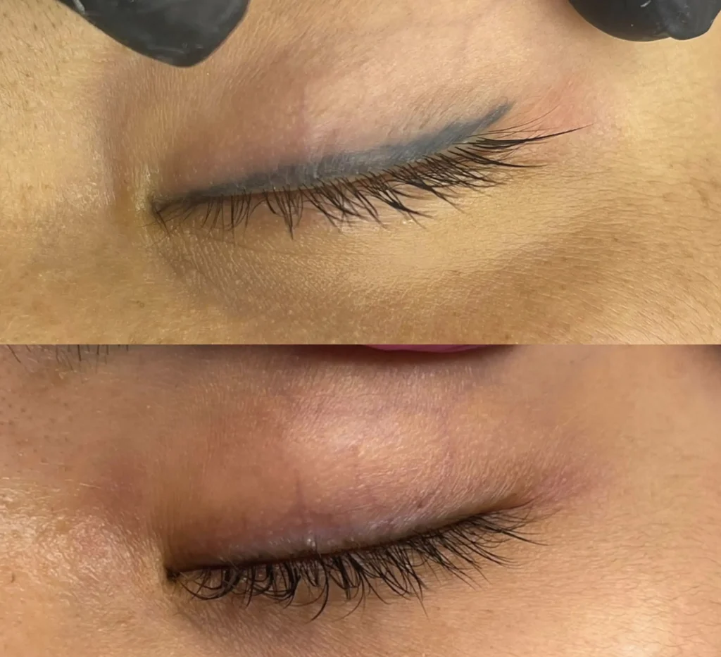 permanent eyeliner tattoo removal